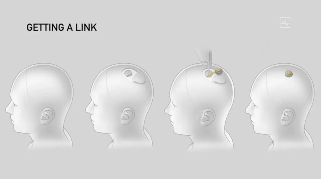 Neuralink протестирует нейроинтерфейс на людях через полгода